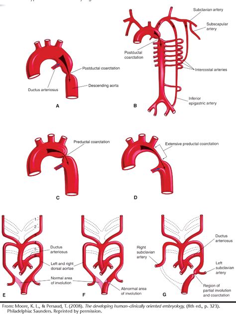 Figure 1 from Coarctation of the aorta: a case presentation. | Semantic Scholar