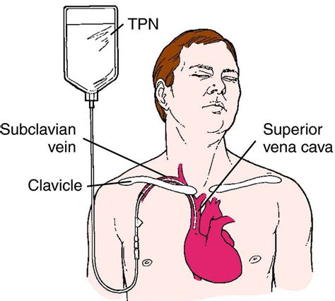 Total parenteral nutrition calculations, guidelines & complications