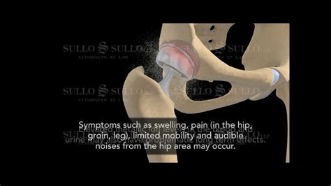 Defective Hip Implant, Depuy hip replacement Recall Video - YouTube