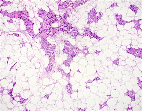 Pathology Outlines - Angiolipoma