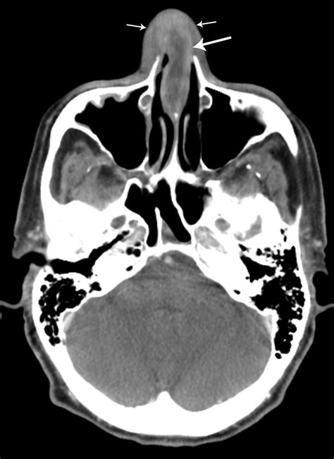 Nasal Septal Hematoma