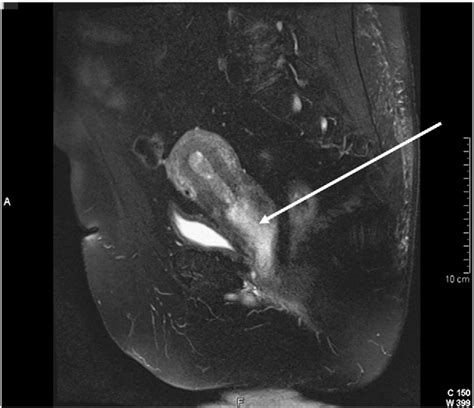 Large lower uterine segment mass.T2 sagittal pelvic MRI with contrast... | Download Scientific ...