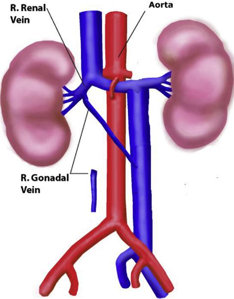 Figure 3 from Right gonadal vein transposition for the treatment of anterior nutcracker syndrome ...