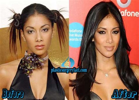 Nicole Scherzinger Plastic Surgery Before and After