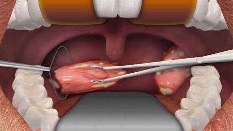 Tonsil Removal Procedure