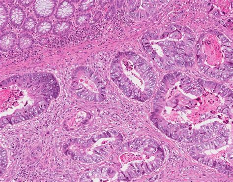 Adenocarcinoma - Colon - MyPathologyReport.ca