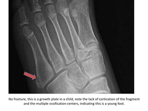 Foot fractures