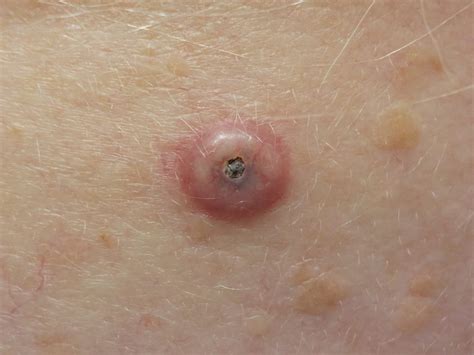 Squamous Cell Carcinoma - Pennsylvania Dermatology Specialists