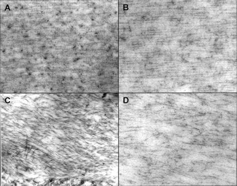 Fibrillin and the eye | British Journal of Ophthalmology