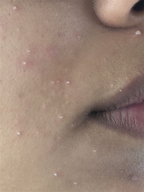 Can anyone explain what this is?? Cluster of small white bumps – General acne discussion – Acne ...