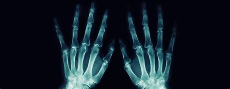 Hand x-ray