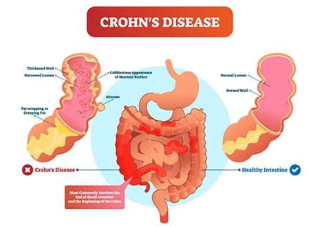 Best Crohn’s Disease Specialists NYC - Professional Product By ...