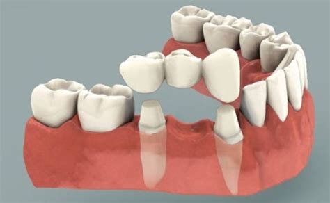 What are dental bridges? dental bridge are false tooth, also known as a "pontic" that are fused ...