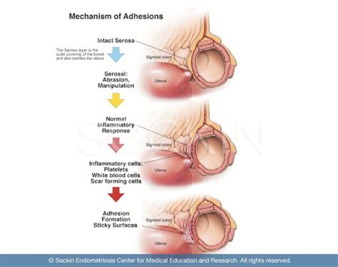 Adhesions and How They Are Treated at Seckin Endometriosis Center