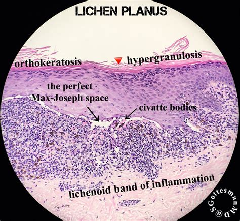 Lichen Planus Histology