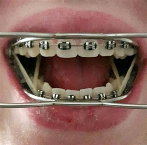 #braces #girlswithbraces #metalbraces #headgear | Tipos de aparelho, Aparelho ortodontico ...