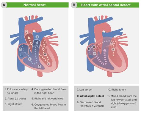 Atrial Septal Defect (ASD): Symptoms, Causes And Treatment, 51% OFF