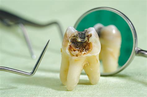 The Stages of Tooth Decay