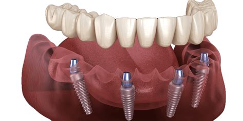 All on 4 Dental Implants: A Revolutionary Tooth Replacement Procedure - 3D Smile Clinic