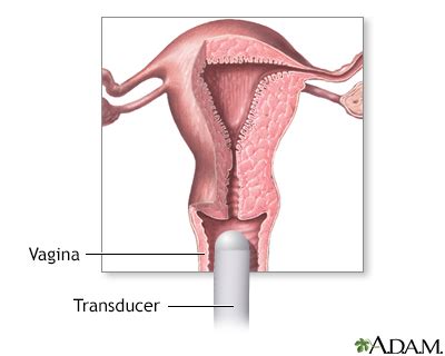 Transvaginal ultrasound Information | Mount Sinai - New York