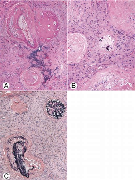 Hilar cell tumor. A, Two vessels (upper left and bottom) were thick ...