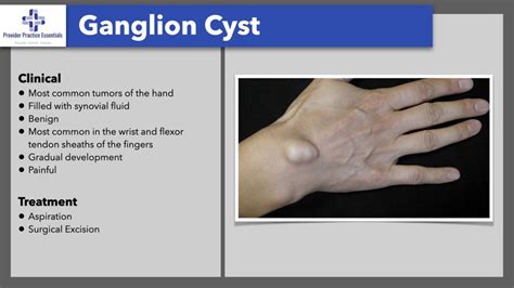 Ganglion Cyst Aspiration