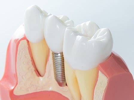 Can I Get Dental Implants if I Have a Metal Allergy?