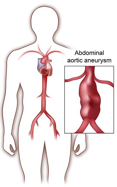 is a heart aneurysm dangerous - Bitter Personal Website Photo Gallery