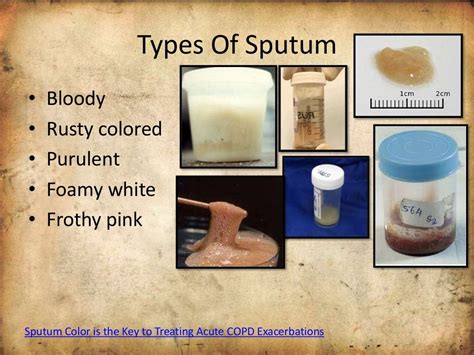 Use of Sputum sample for diagnosis of disease, interpretation, treatm…