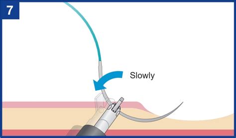 Basic operation and techniques for Endoscopic Hand-Suturing with ...