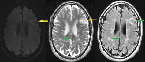 Tumefactive multiple sclerosis presenting with tonic–clonic seizure ...