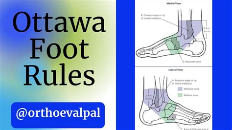 Ottawa Foot Rules-"To x-ray or not to x-ray" - YouTube