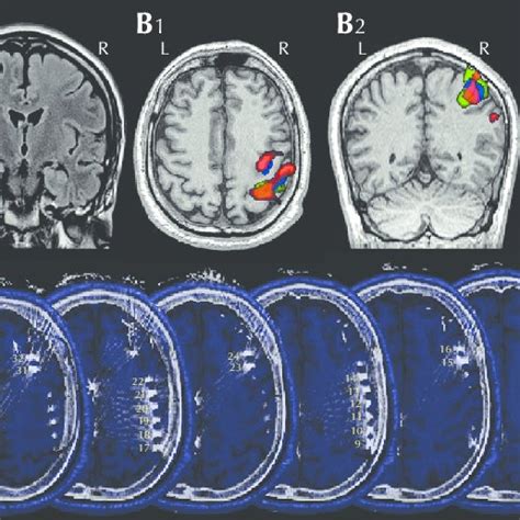 Imaging and invasive ECoG study. (A 1 ) Pre-operative axial FLAIR MRI... | Download Scientific ...