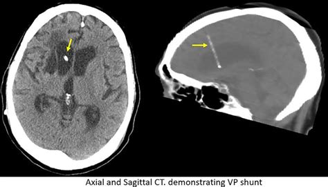 Axial and sagittal CT demonstrating ventriculoperitoneal (VP) shunt. | Download Scientific Diagram