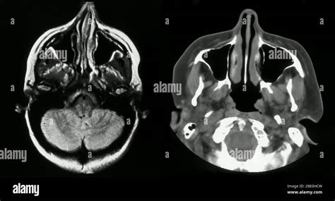 MRIs showing the normal brain and sinuses Stock Photo - Alamy