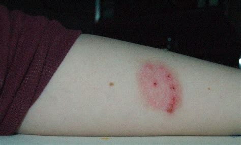 What are the most commonest spider bite symptoms? [with pictures]