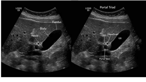 Gallbladder Anatomy Ultrasound