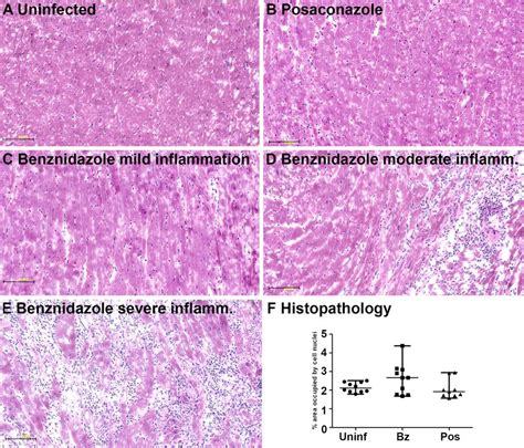 (A-E) Inflammatory infiltrates associated with parasite infection, in ...