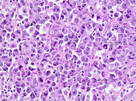 Pathology Outlines - Anaplastic large cell lymphoma, ALK positive