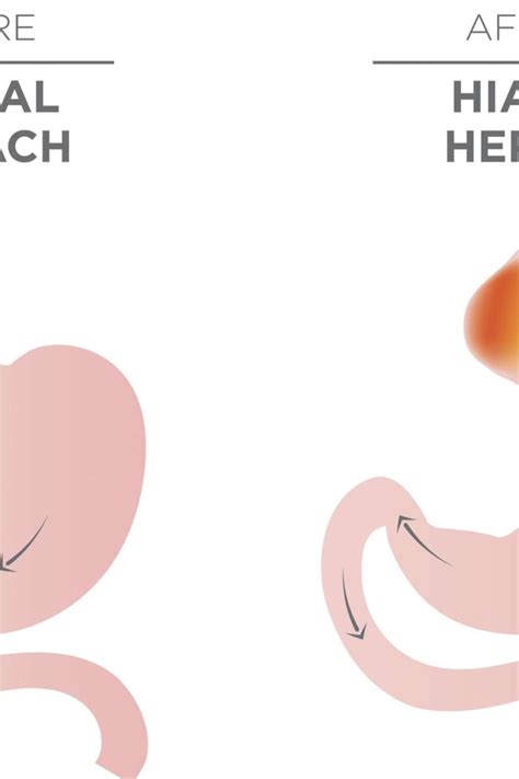 Hiatal hernia surgery: Procedure, recovery, and outlook