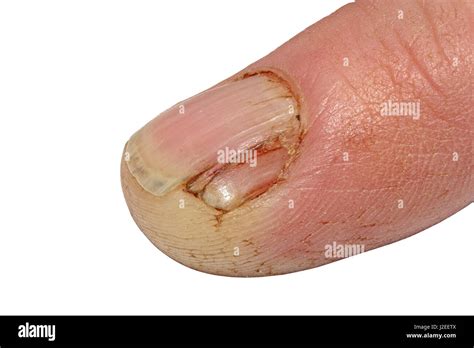 A Damaged Split and Cracked finger nail isolated on a white background ...