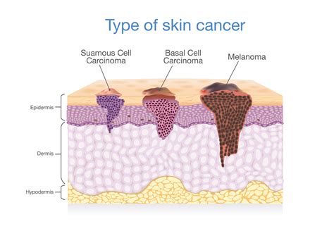 Images Of Different Types Of Skin Cancer