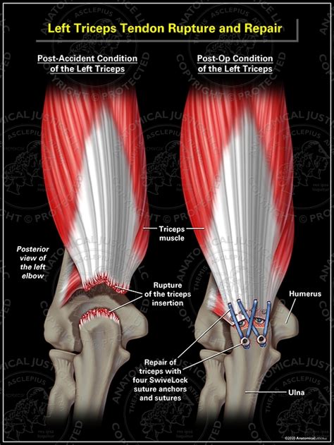 Left Triceps Tendon Rupture and Repair