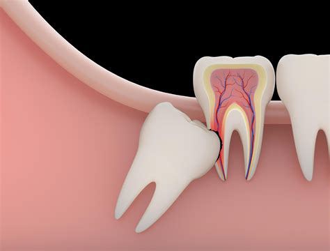 Wisdom Tooth Extractions - Mount Pleasant Medical & Dental Centre