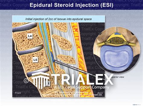 Epidural Steroid Injection (ESI) - TrialExhibits Inc.