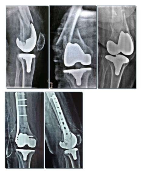 Distal Femur Fracture Classification