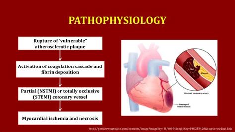 ST-Elevation Myocardial Infarction