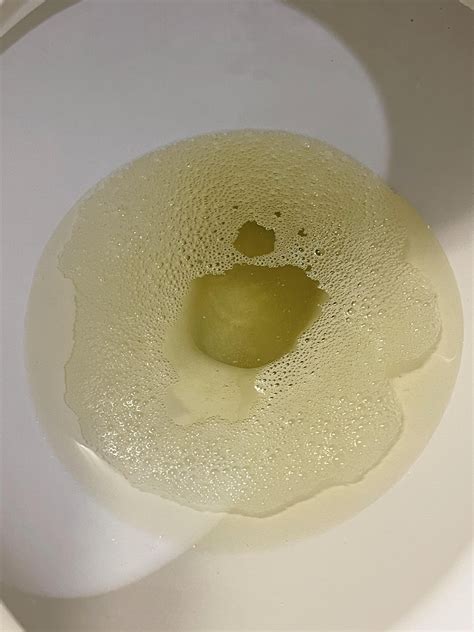 Foamy urine or bubbles? Same urine 10 seconds apart : r/KidneyStones