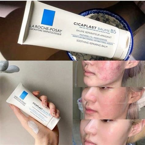 CICAPLAST Baume B5 soothing repairing balm for acne prone skin REVIEW+ AFTER AND BEFORE in 2024 ...