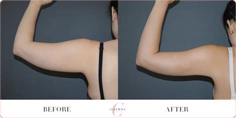 Arm Liposuction Before & After - Explore The Outcomes Online